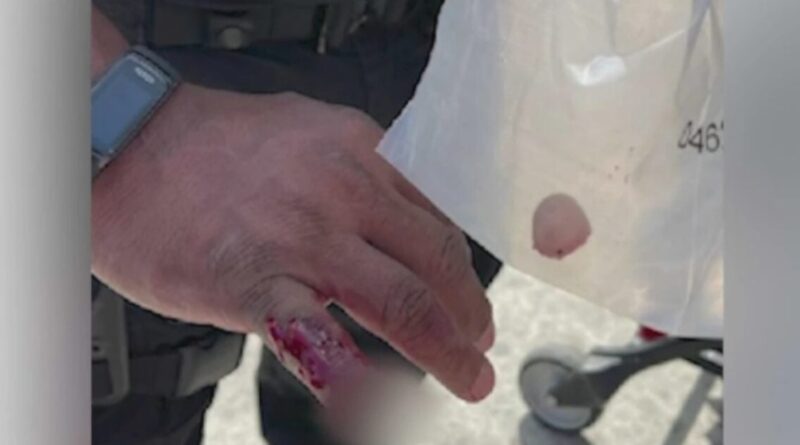 LAPD Officer Has Finger Bitten Off By Homeless Man Who Was Resisting Arrest | The Gateway Pundit | by Cassandra MacDonald